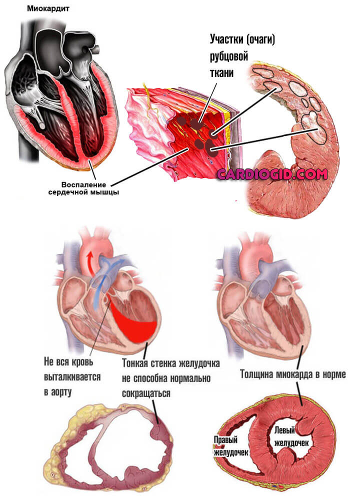 Миокарда левой стенки. Миокардит последствия заболевания. Микардмн. Воспаление миокарда миокардит.